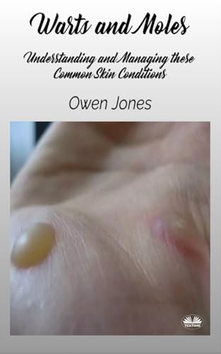 Warts And Moles: Understanding And Managing These Common Skin Conditions von Tektime