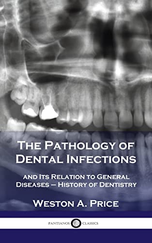 Pathology of Dental Infections: and Its Relation to General Diseases - History of Dentistry Pathology of Dental Infections: and Its Relation to General Diseases - History of Dentistry von Pantianos Classics