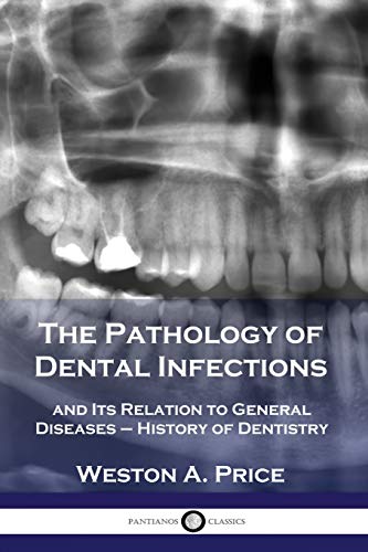 The Pathology of Dental Infections: and Its Relation to General Diseases - History of Dentistry von Pantianos Classics