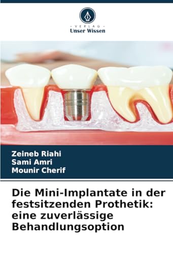 Die Mini-Implantate in der festsitzenden Prothetik: eine zuverlässige Behandlungsoption von Verlag Unser Wissen