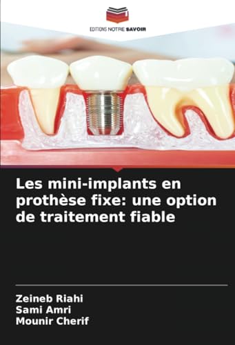 Les mini-implants en prothèse fixe: une option de traitement fiable von Editions Notre Savoir