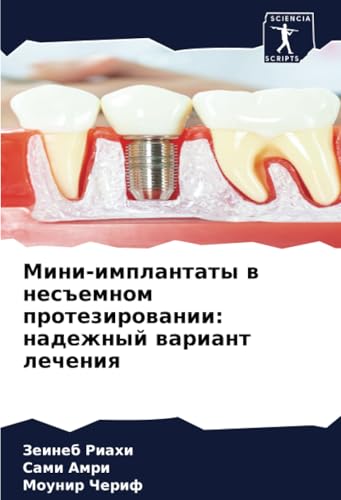 Мини-имплантаты в несъемном протезировании: надежный вариант лечения: DE von Sciencia Scripts
