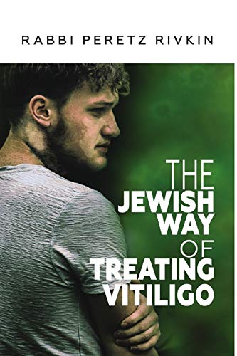 The Jewish Way of Treating Vitiligo von Lulu