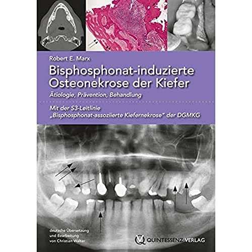 Bisphosphonat-induzierte Osteonekrose der Kiefer: Ätiologie, Prävention, Behandlung von Quintessence Publishing