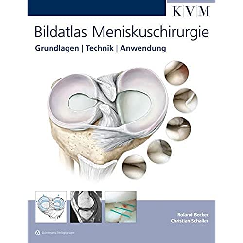 Bildatlas Meniskuschirurgie: Grundlagen | Technik | Anwendung von KVM-Der Medizinverlag