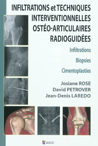 INFILTRATIONS ET TECHNIQUES INTERVENTIONNELLES OSTEO-ARTICULAIRES RADIOGUIDEES (0000): Infiltrations, Biopsies, Cimentoplasties von SAURAMPS MEDICA