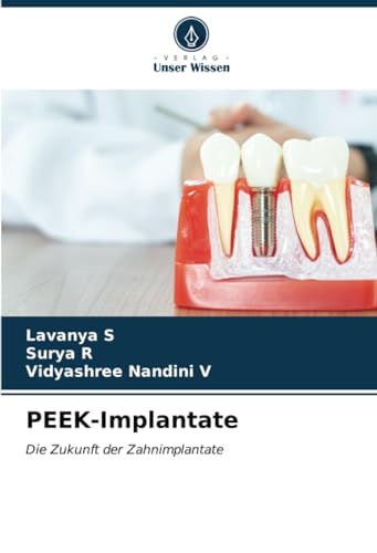 PEEK-Implantate: Die Zukunft der Zahnimplantate von Verlag Unser Wissen