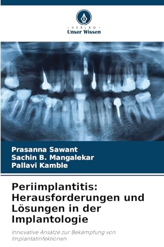 Periimplantitis: Herausforderungen und Lösungen in der Implantologie: Innovative Ansätze zur Bekämpfung von Implantatinfektionen von Verlag Unser Wissen