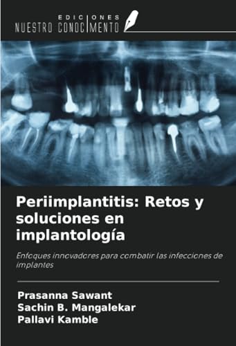 Periimplantitis: Retos y soluciones en implantología: Enfoques innovadores para combatir las infecciones de implantes von Ediciones Nuestro Conocimiento