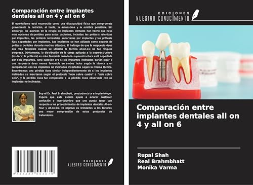 Comparación entre implantes dentales all on 4 y all on 6 von Ediciones Nuestro Conocimiento