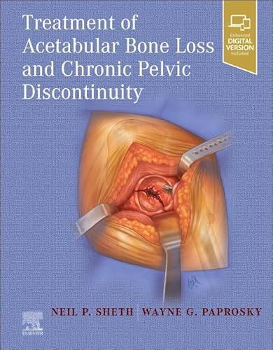 Treatment of Acetabular Bone Loss and Chronic Pelvic Discontinuity von Elsevier