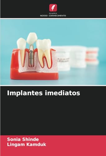 Implantes imediatos: DE von Edições Nosso Conhecimento