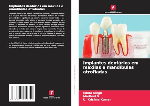 Implantes dentários em maxilas e mandíbulas atrofiadas von Edições Nosso Conhecimento