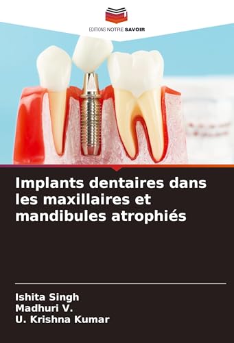 Implants dentaires dans les maxillaires et mandibules atrophiés von Editions Notre Savoir