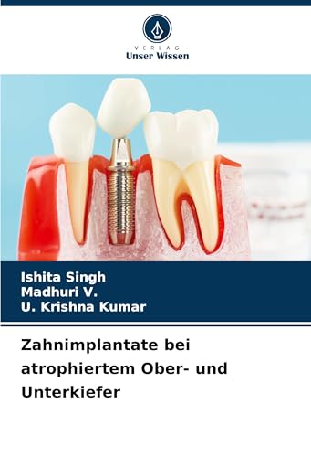 Zahnimplantate bei atrophiertem Ober- und Unterkiefer: DE von Verlag Unser Wissen