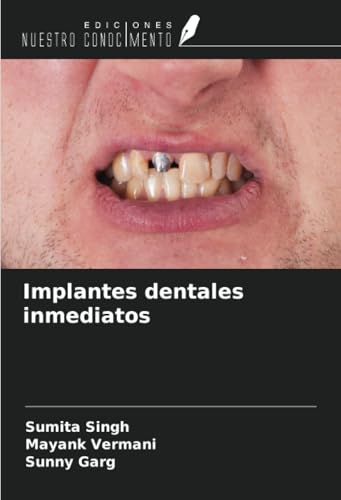 Implantes dentales inmediatos von Ediciones Nuestro Conocimiento