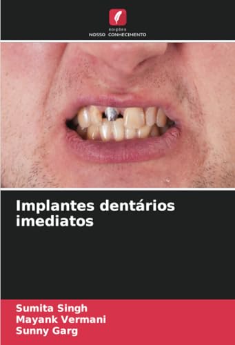 Implantes dentários imediatos von Edições Nosso Conhecimento