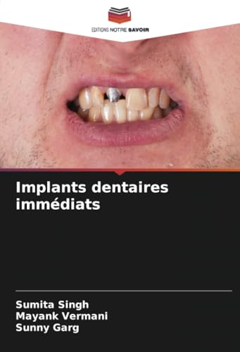 Implants dentaires immédiats von Editions Notre Savoir