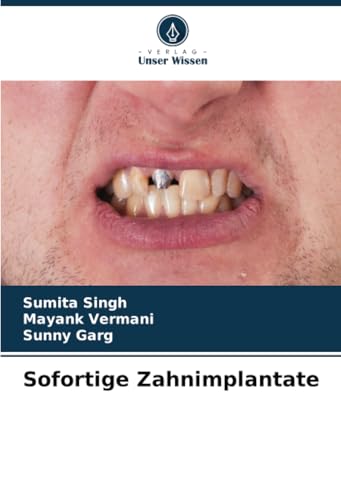 Sofortige Zahnimplantate: DE von Verlag Unser Wissen