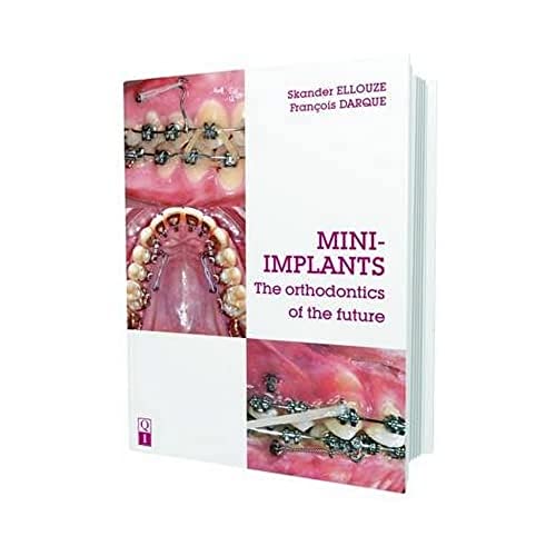 Mini-Implants: The orthodontics of the future