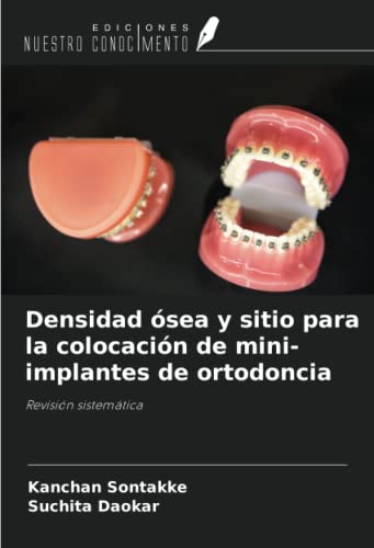 Densidad ósea y sitio para la colocación de mini-implantes de ortodoncia: Revisión sistemática von Ediciones Nuestro Conocimiento