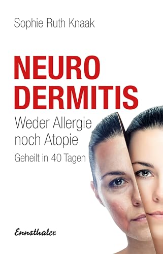 Neurodermitis: Weder Allergie noch Atopie - Geheilt in 40 Tagen