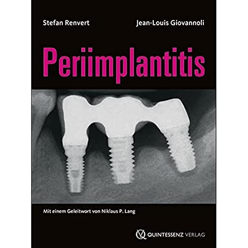 Periimplantitis von Quintessenz Verlag