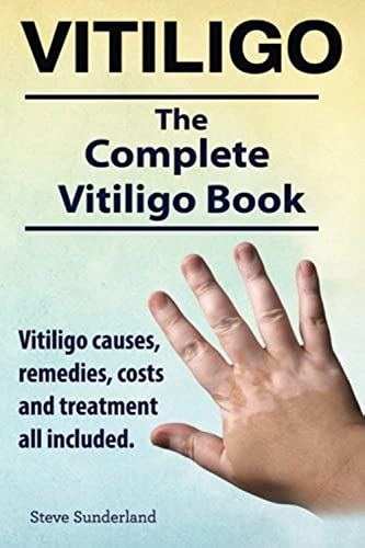 Vitiligo. Vitiligo causes, remedies, costs and treatment all included. The complete Vitiligo Book. Vitiligo. Vitiligo causes, remedies, costs and treatment all included. The complete Vitiligo Book.