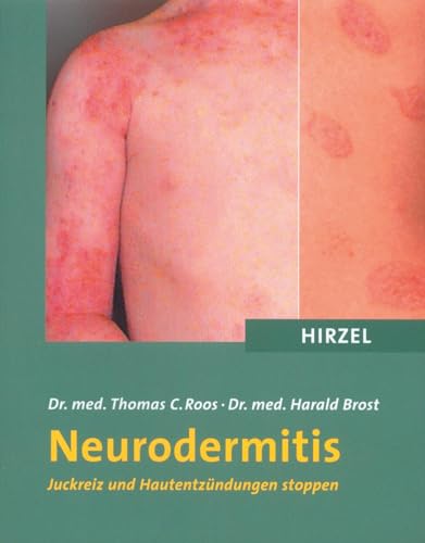 Neurodermitis. Juckreiz und Hautentzündungen stoppen von Hirzel S. Verlag