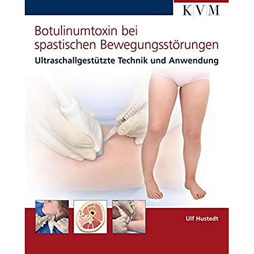 Botulinumtoxin bei spastischen Bewegungsstörungen: Ultraschallgestützte Technik und Anwendung von Kvm