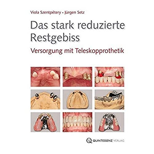 Das stark reduzierte Restgebiss: Versorgung mit Teleskopprothetik