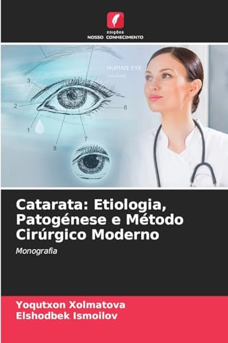 Catarata: Etiologia, Patogénese e Método Cirúrgico Moderno: Monografia von Edições Nosso Conhecimento