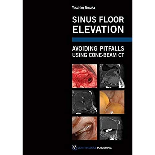 Sinus Floor Elevation: Avoiding Pitfalls Using Cone-Beam CT Sinus Floor Elevation: Avoiding Pitfalls Using Cone-Beam CT von Quintessence Publishing