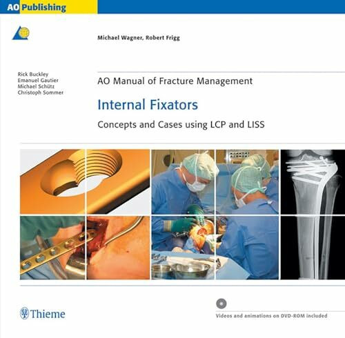AO Manual of Fracture Management: Internal Fixators: Concepts and Cases using LCP/LISS AO Manual of Fracture Management: Internal Fixators: Concepts and Cases using LCP/LISS