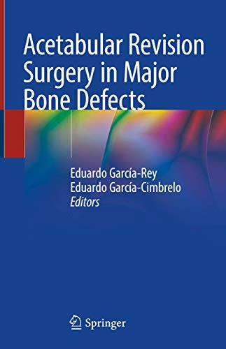 Acetabular Revision Surgery in Major Bone Defects von Springer