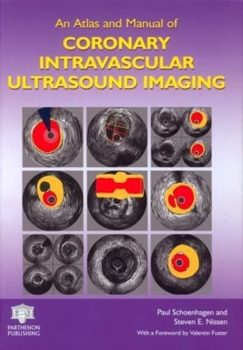 An Atlas and Manual of Coronary Intravascular Ultrasound Imaging von CRC Press
