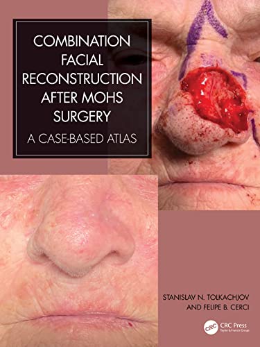 Combination Facial Reconstruction After Mohs Surgery: A Case Based Atlas von CRC Press