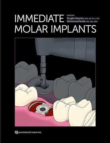 Immediate Molar Implants von Quintessence Publishing Co